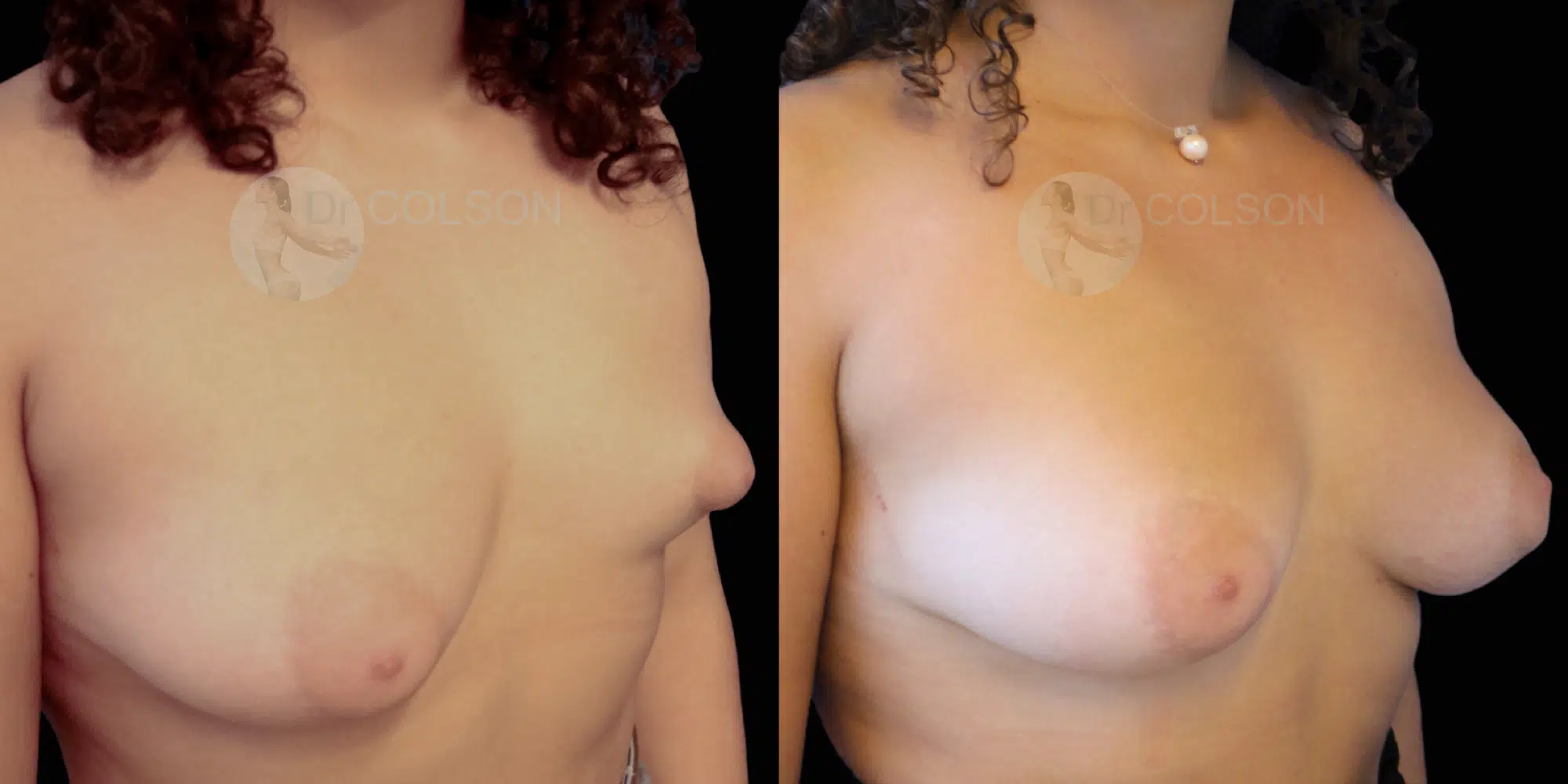 Dr Colson - Chirurgie sein - Asymetrie Trois Quart