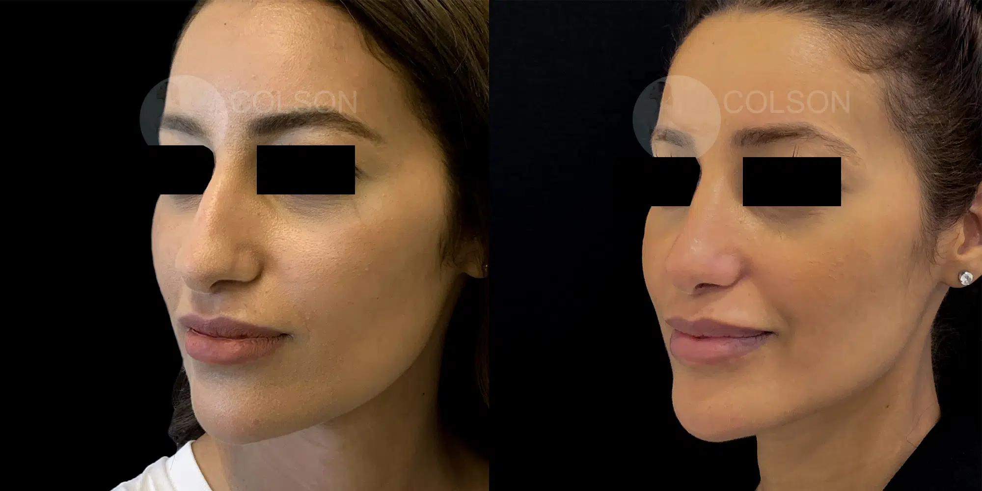 Dr Colson - Chirurgie visage - Rhinoplastie Trois Quart