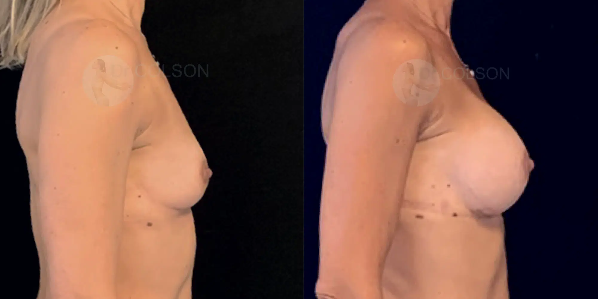 Dr Colson - Chirurgie sein - Augmentation Mammaire Profil