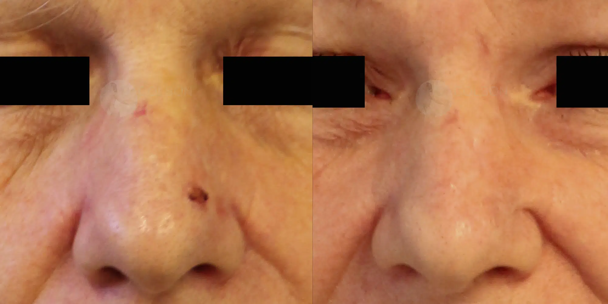 Dr Colson - Chirurgie peau - Tumeur cutanee Face