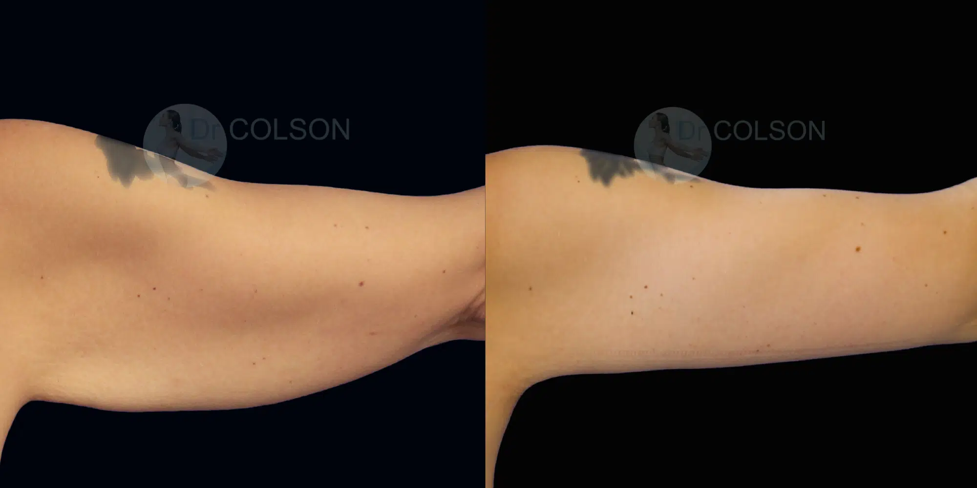 Dr Colson - Chirurgie silhouette - Lifting Bras Vue de Dos 2