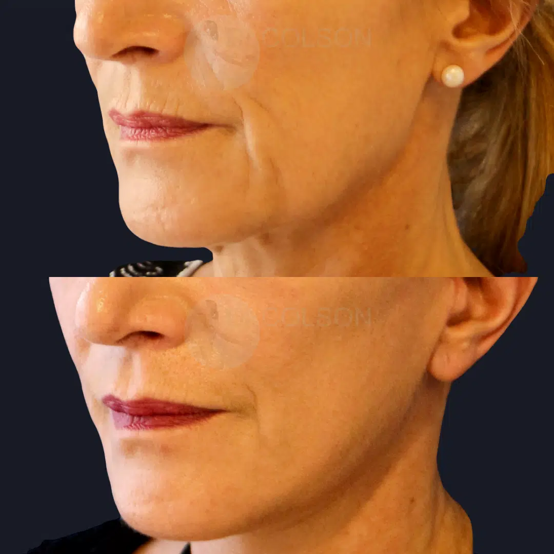 Dr Colson - Chirurgie visage - Lifting Visage Trois Quart